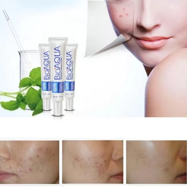 Bioaqua Pure Acne Treatment Scar Removal Cream Dark Spot - image 4