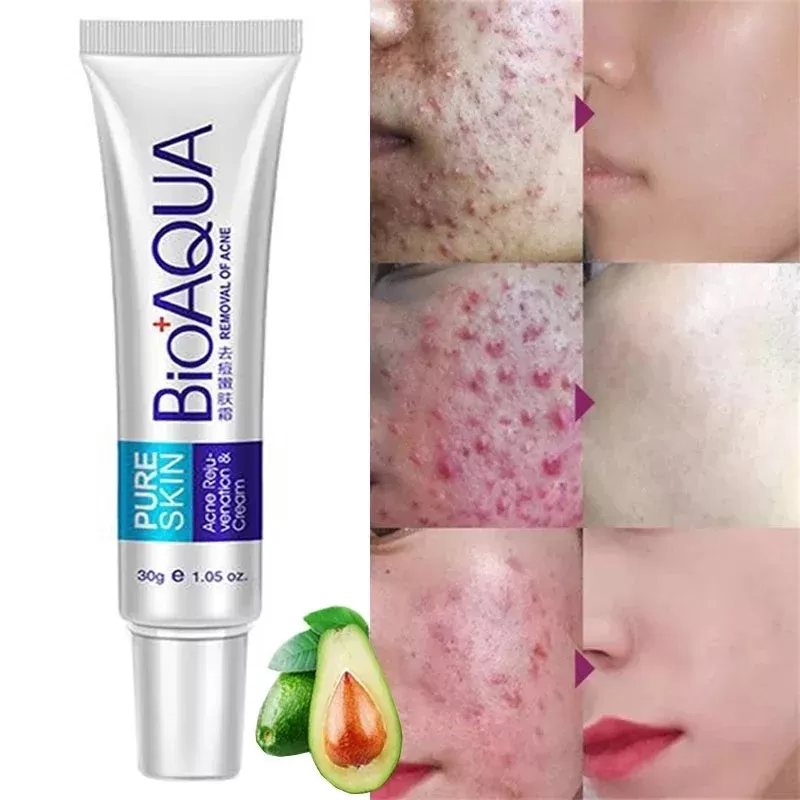 Bioaqua Pure Acne Treatment Scar Removal Cream Dark Spot - image 1