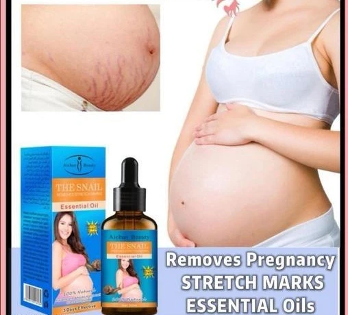 Aichun Beauty Snail Essential Oil Stretch Mark Remover - image 1
