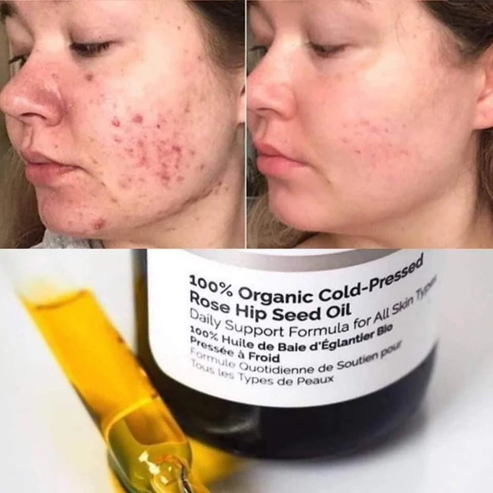 The Ordinary Rose Hip Seed Oil Organic Cold-Pressed 30ml - image 11