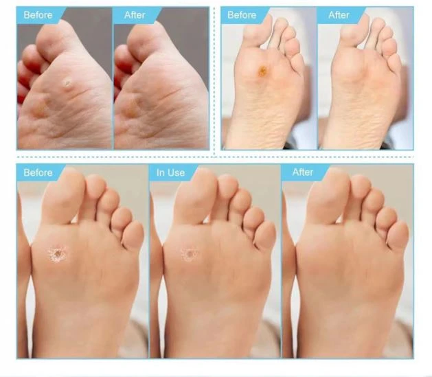 Generic Foot Corn Plaster Patches for Corn Removal - image 4