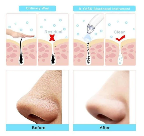 Derma Suction Electric Vacuum Blackhead Remover Kit - image 5