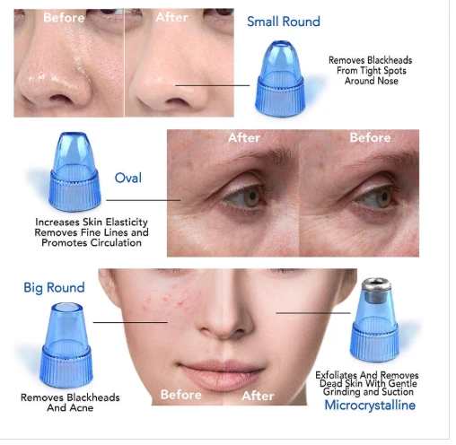 Derma Suction Electric Vacuum Blackhead Remover Kit - image 6